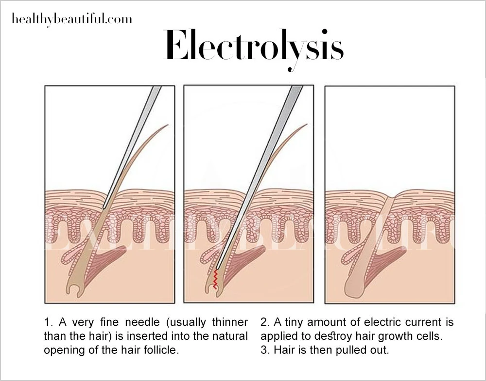 Image: The Process of Electrolysis
