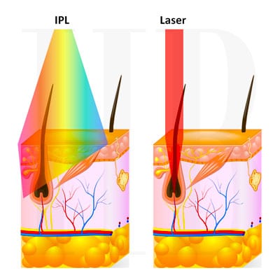 Figure 3.1. Lasers generate a single wavelength that is extremely concentrated and efficiently absorbed by the pigment in the hair. IPL creates a wide spectrum of light where only some wavelengths are absorbed by the pigment in the hair and some by the skin.