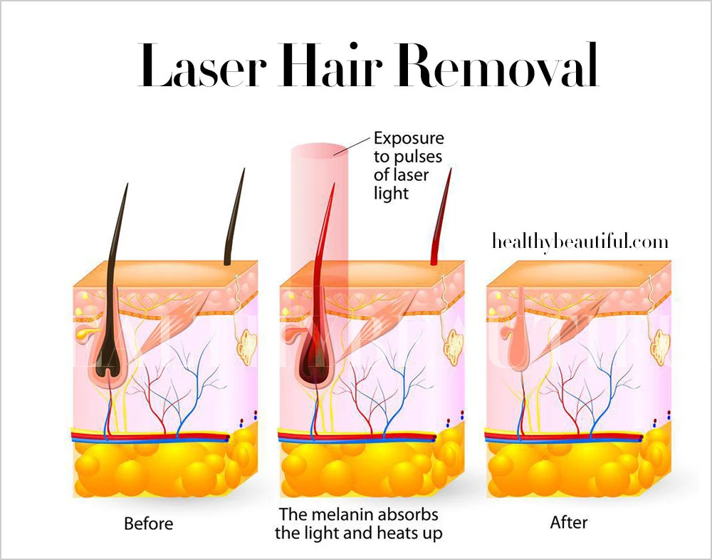 Image: The process of laser hair removal