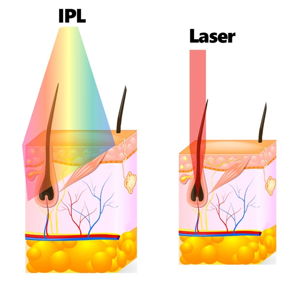 ipl laser diagram