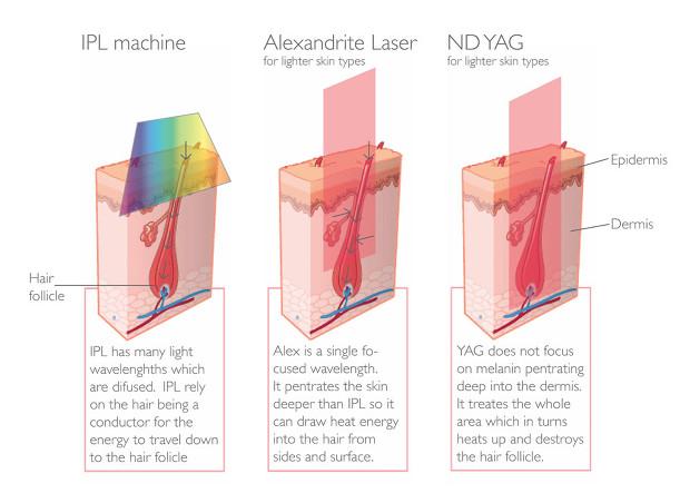 Laser Hair Removal Technology
