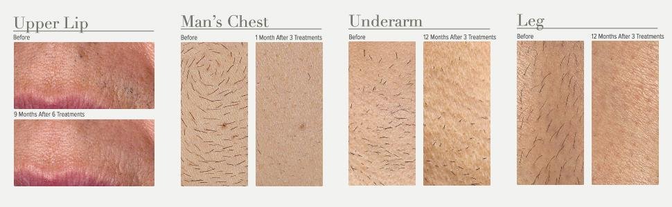 lumarx 94% hair reduction in just 3 treatments
