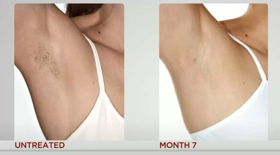 Location: Underarm. Treatment: Every other week for 3 months. Without hair, the skin is smooth and soft.
