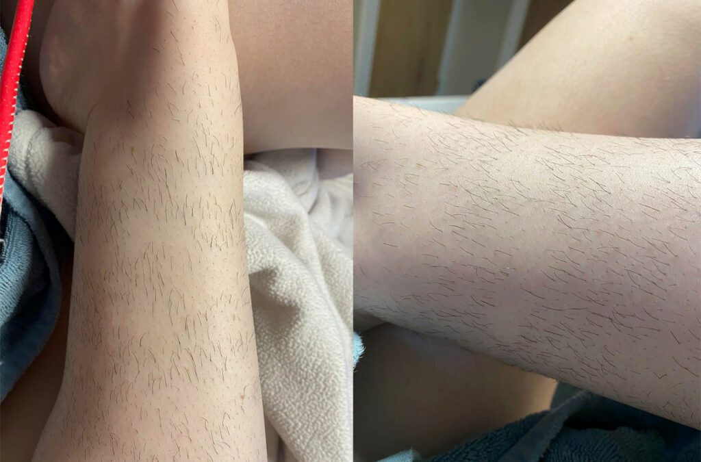 Images: Example of missed spots using IPL after one session. /reddit.com