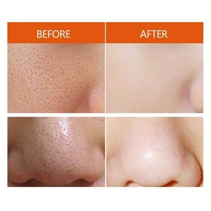 Regularly unclogging pores to prevent build-up can minimize the appearnce of pores.